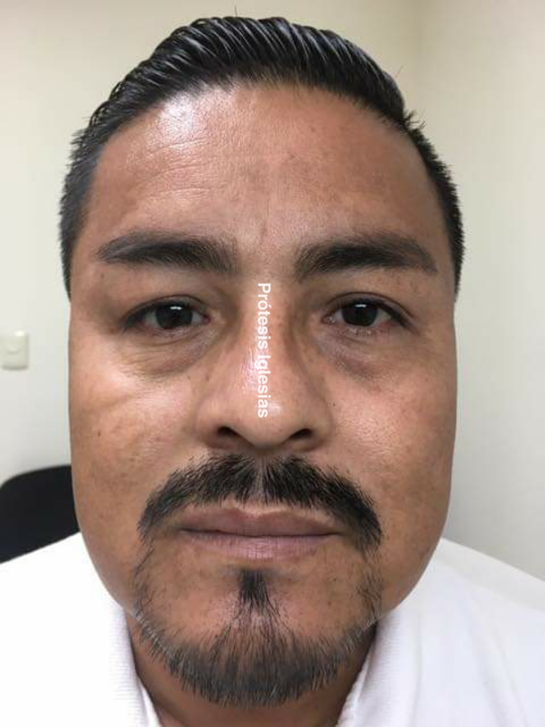 Prótesis ocular personalizada - Retinoblastoma tratamiento - Ocularista especializado