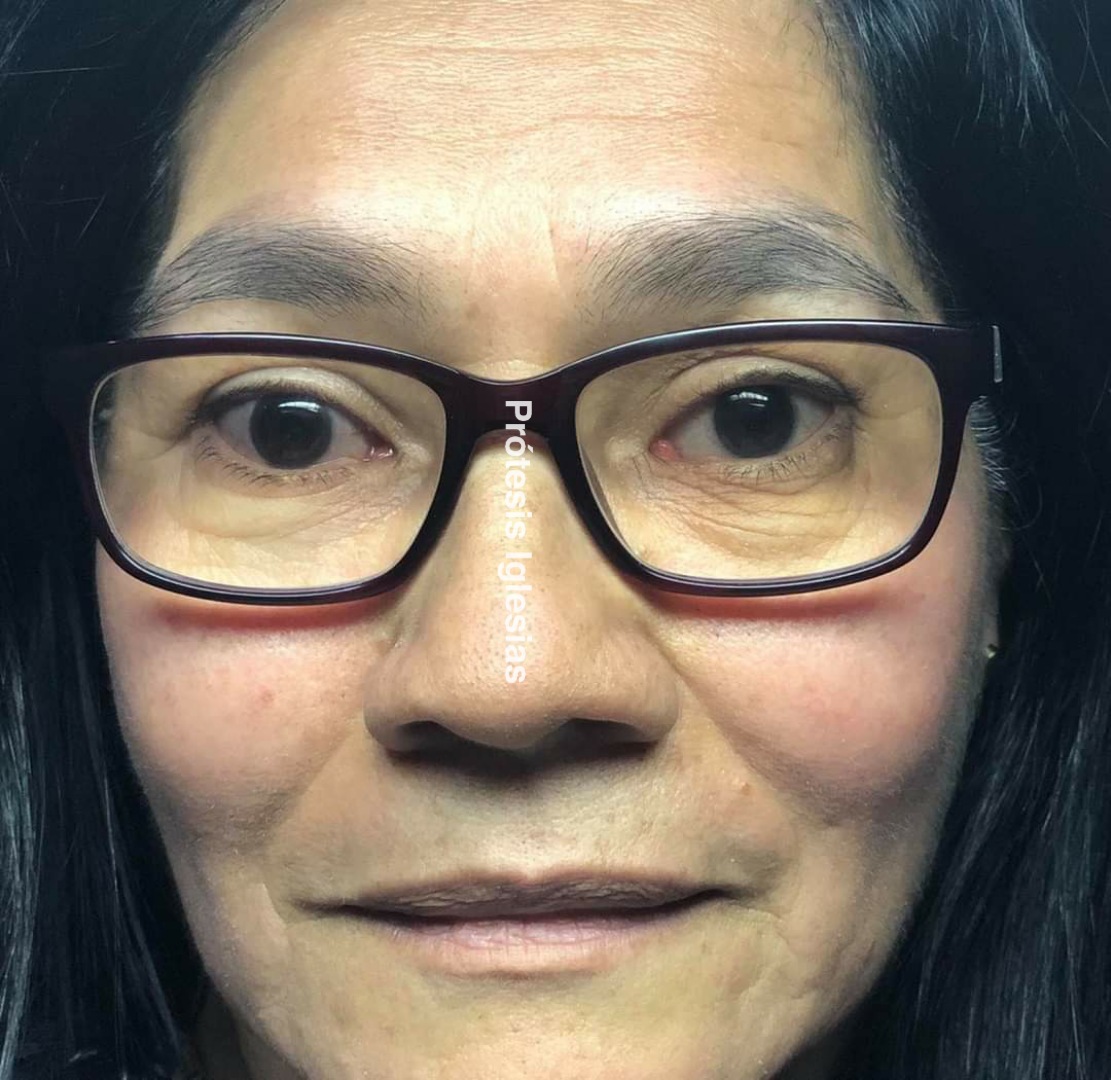 Prótesis ocular México - Melanoma ocular - Solución estética profesional