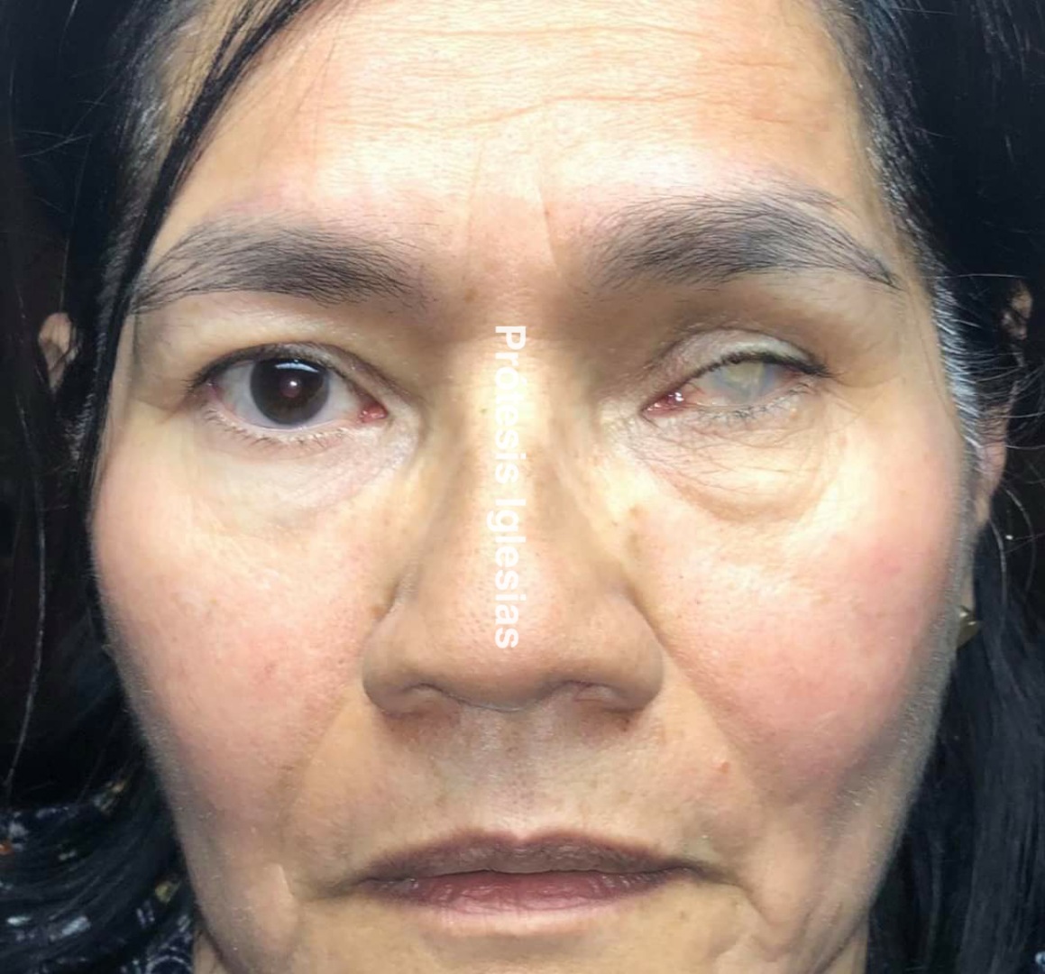 Prótesis ocular Centroamérica - Infección ocular severa - Recuperación cosmética