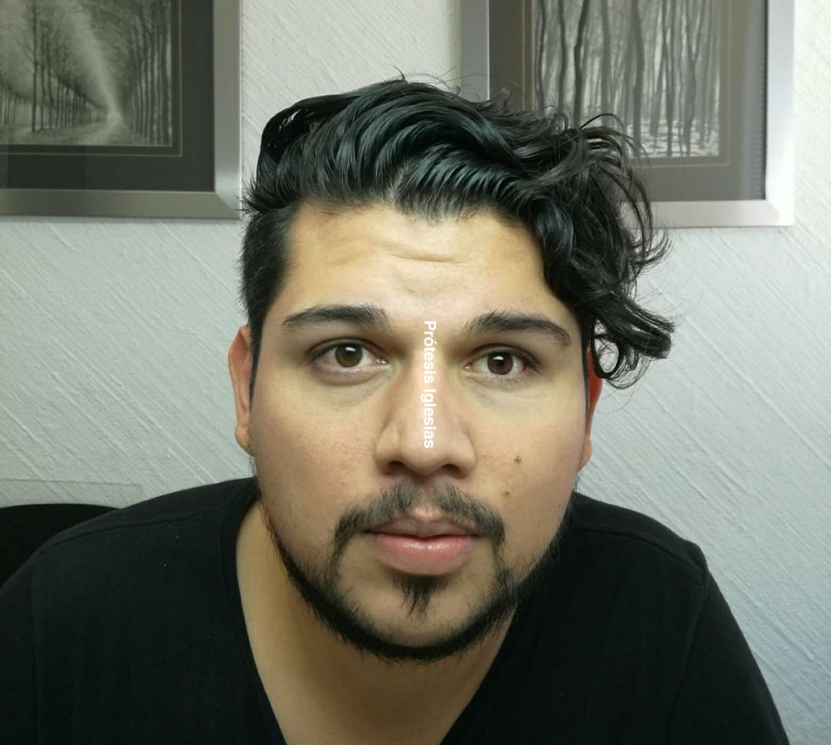 Prótesis ocular CDMX - Cirugía complicada - Recuperación con ocularista ASO