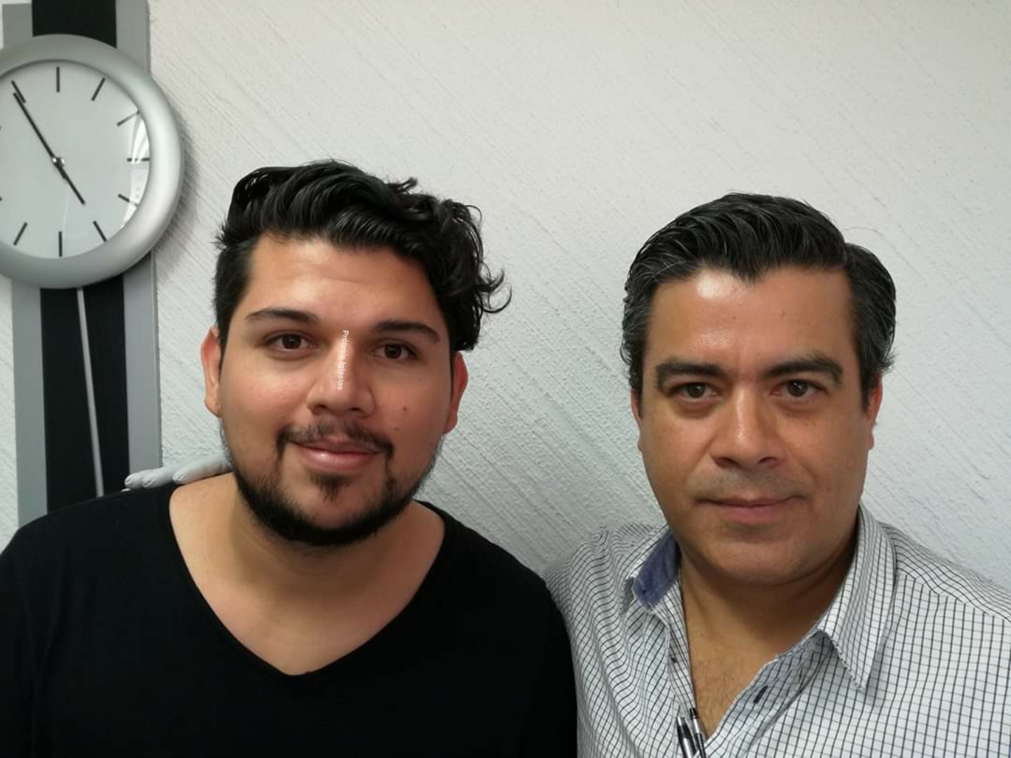 Prótesis ocular completa México - Enucleación por tumor - Resultado natural garantizado