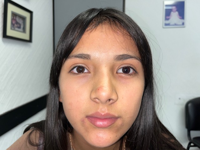Concha esclerocorneal Guadalajara - Ojo no funcional - Cobertura estética completa