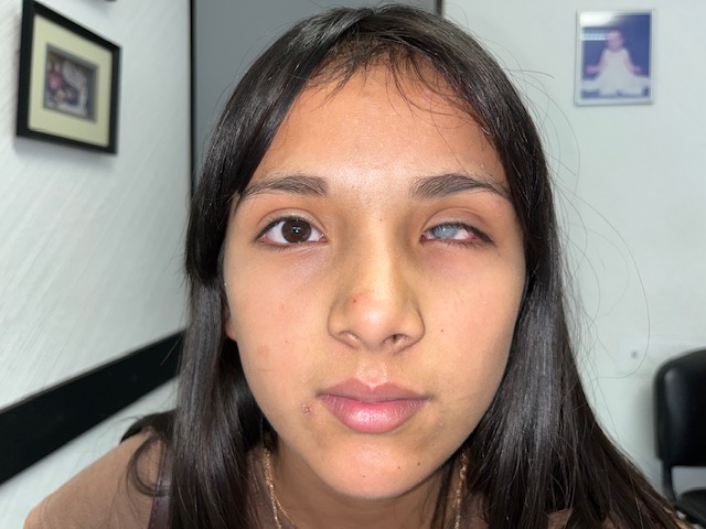 Prótesis ocular completa CDMX - Postoperatorio - Seguimiento ocularista profesional