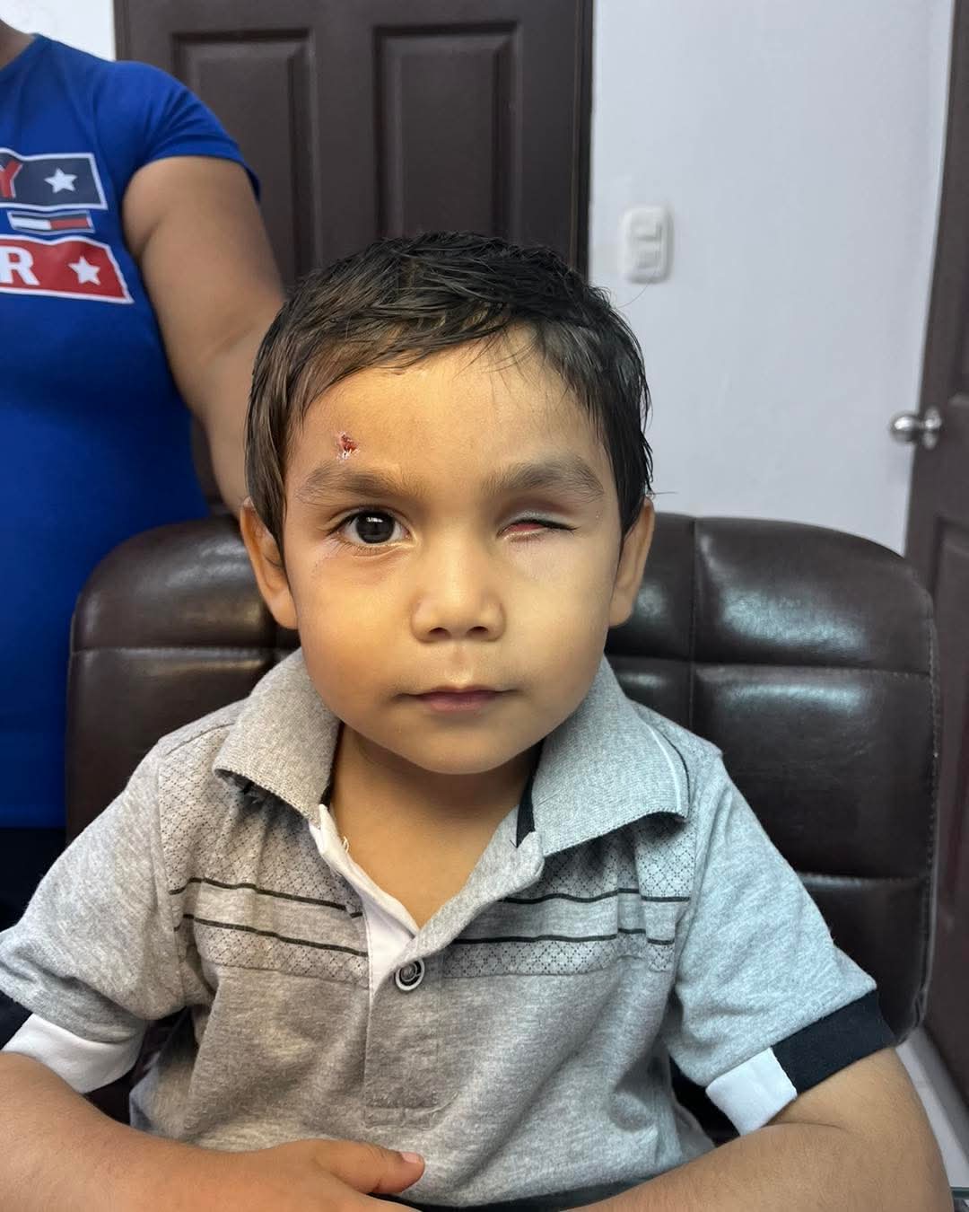 Prótesis ocular ergonómica Guatemala - Adaptación progresiva - Acompañamiento profesional