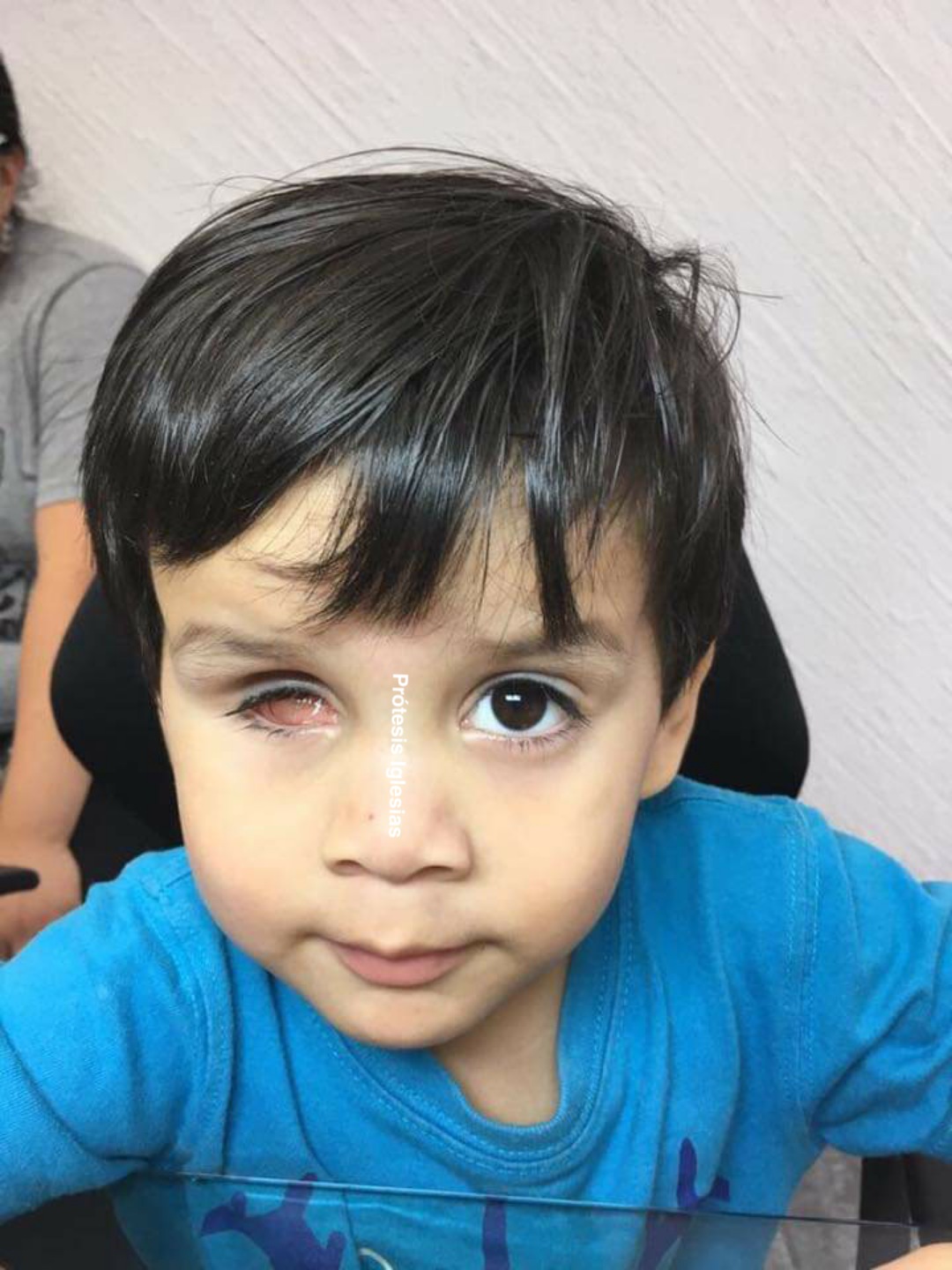 Prótesis ocular Nicaragua - Acrílico grado médico - Biocompatibilidad garantizada