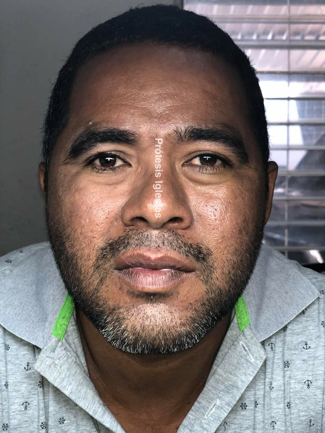 Ojo artificial Guadalajara - Ajuste perfecto - Comodidad prolongada