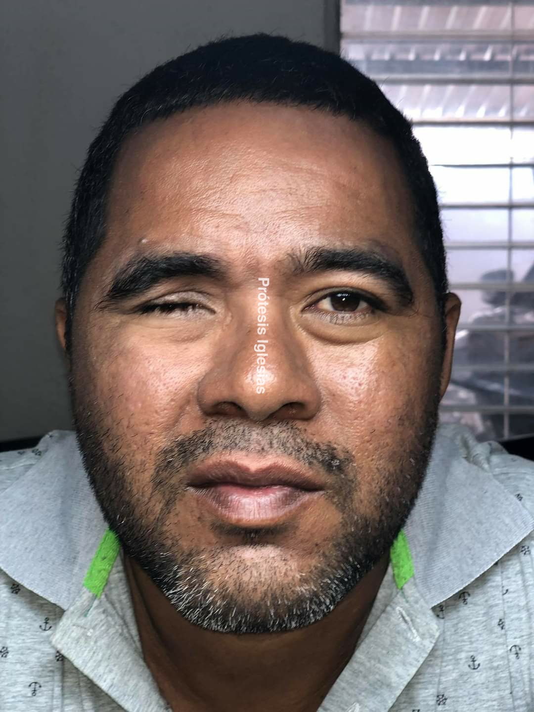 Prótesis ocular CDMX - Recuperación estética - Autoestima restaurada